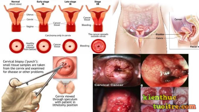 Ảnh 2 của Cervical cancer